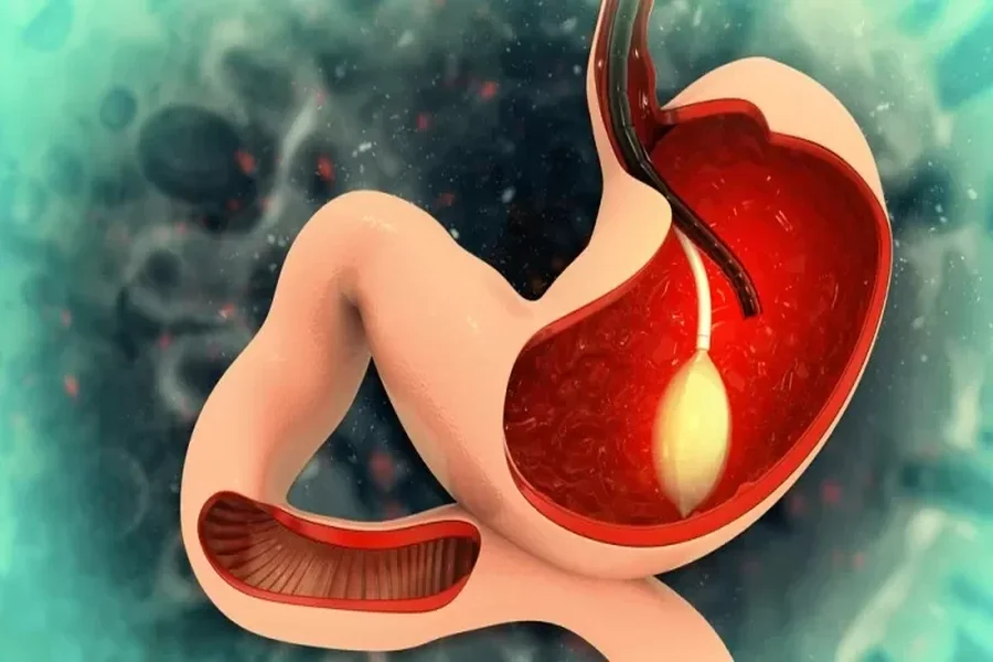 Gastric Balloon: A Non-Surgical Approach to Weight Loss