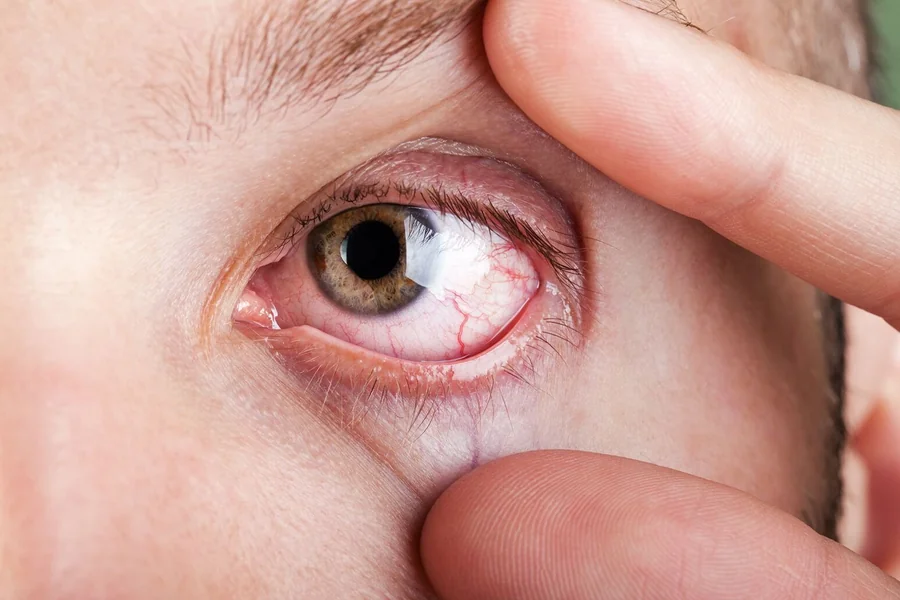Eye Diseases