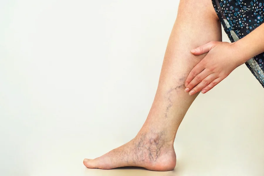 What are the Main Causes Of Varicose Veins